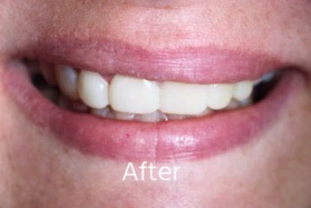 After Cosmetic Bonding Case 1