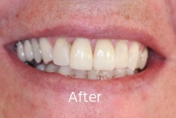 After Cosmetic Bonding Case 2
