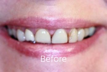 Before Cosmetic Bonding Case 1