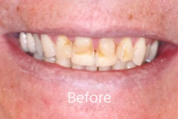 Before Cosmetic Bonding Case 2