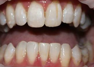 After orthodontic transformation: Diastema Space Closure & Midline Realignment