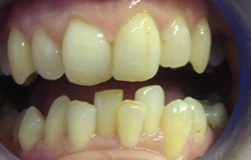 Before orthodontic treatment: Diastema Space Closure & Midline Realignment
