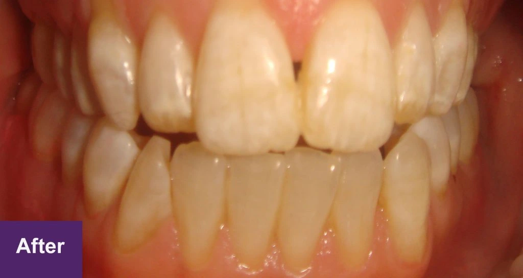 After 6 Month Smiles Case 1