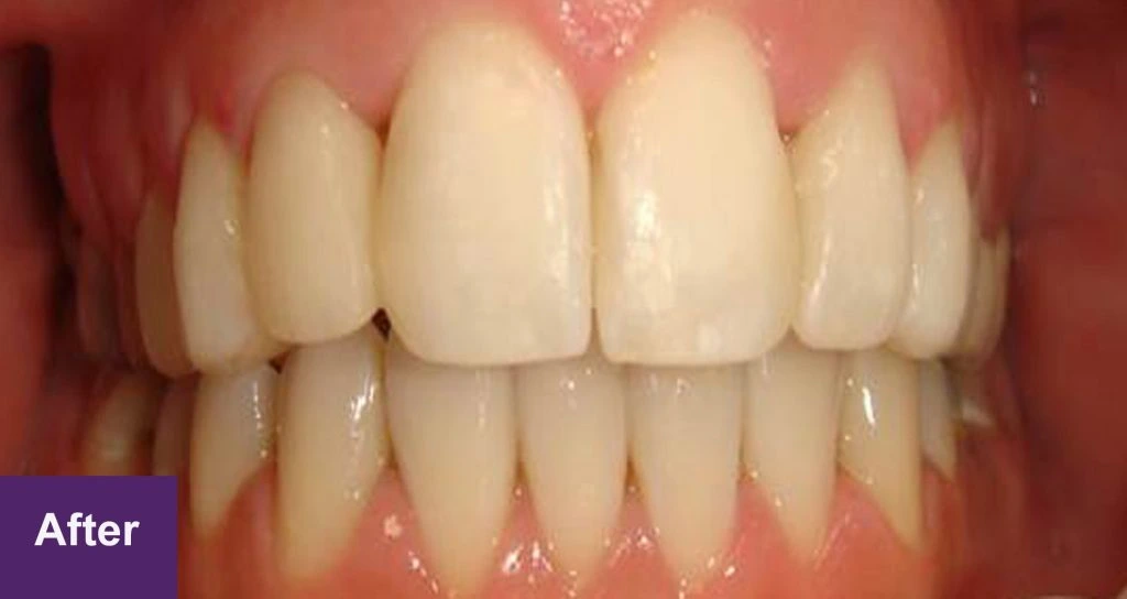 After 6 Month Smiles Case 2