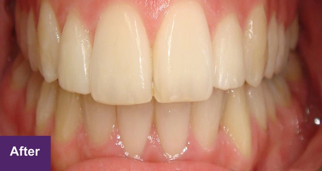 After 6 Month Smiles Case 3