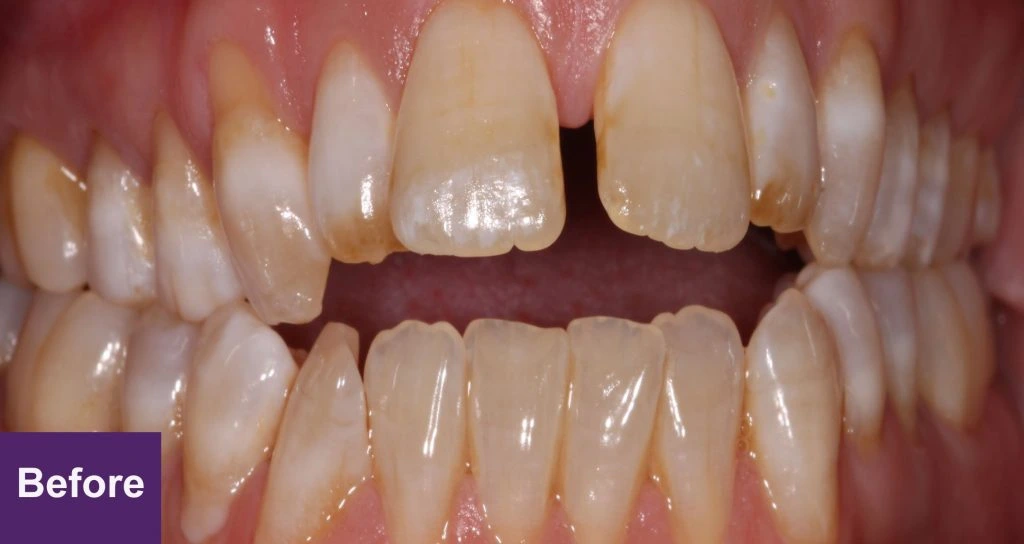 Before 6 Month Smiles Case 1
