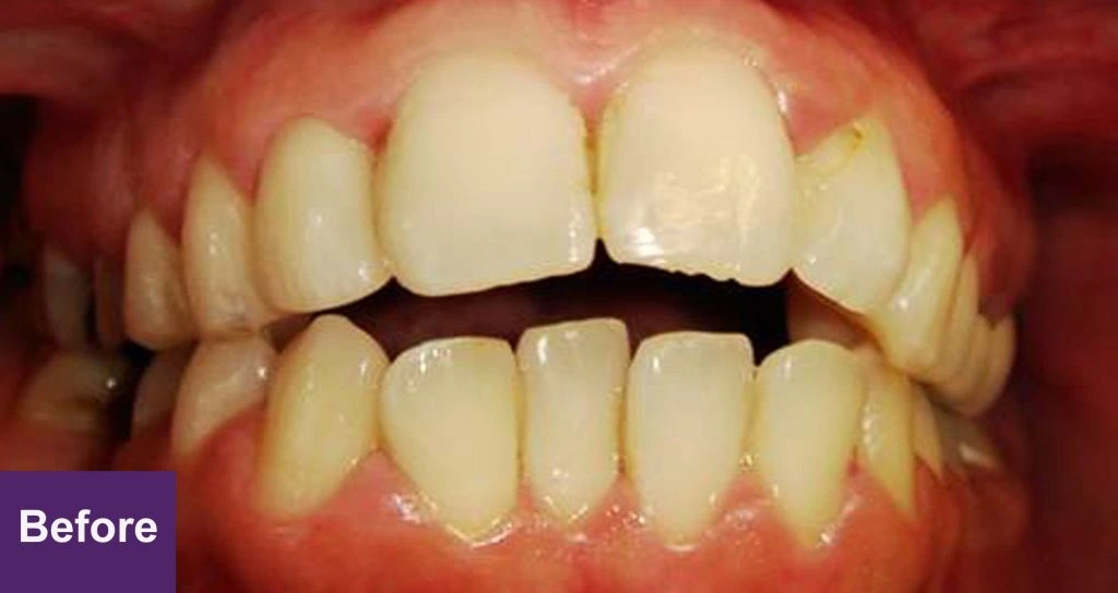 Before 6 Month Smiles Case 2