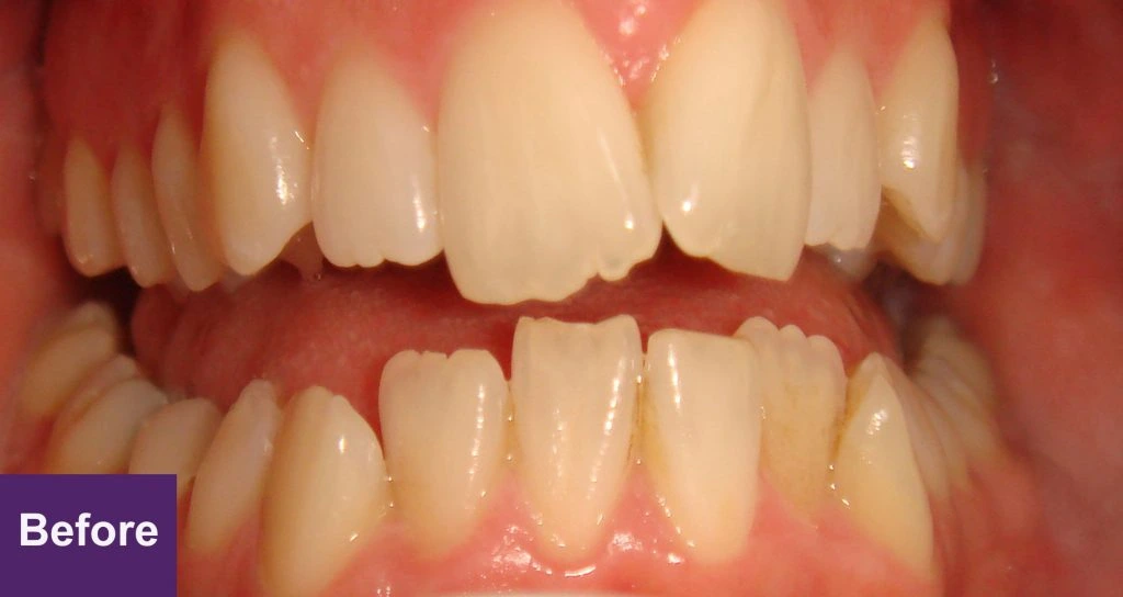 Before 6 Month Smiles Case 3