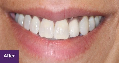 After Smile Makeover Case 1