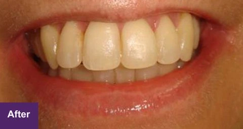 After Smile Makeover Case 2