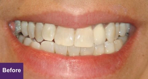 Before Smile Makeover Case 1