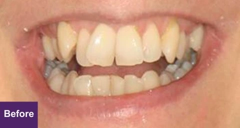 Before Smile Makeover Case 2