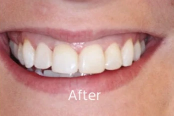 After orthodontic transformation: Anterior Crowding & Overlap Correction