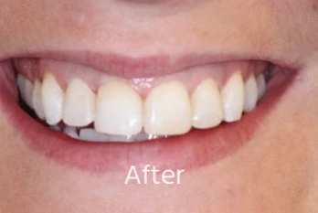 After Teeth Straightening Case 1