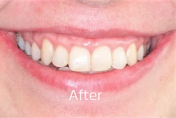 After orthodontic transformation: Deep Bite & Anterior Arch Harmony