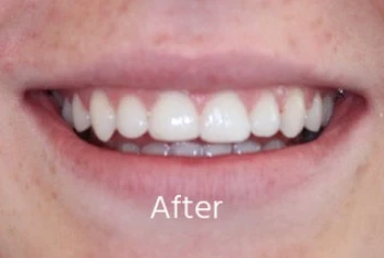 After orthodontic transformation: Anterior Crossbite & Palatal Arch Expansion