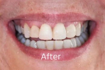 After orthodontic transformation: Severe Incisor Rotation & Leveling