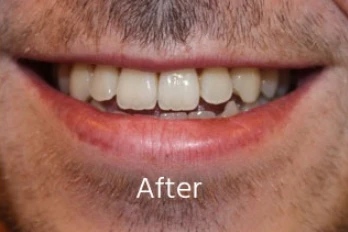 After orthodontic transformation: Open Bite Closure & Aesthetic Smile Line