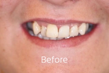 Before Teeth Straightening Case 1