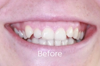 Before Teeth Straightening Case 3