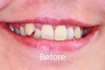 Before orthodontic treatment: Deep Bite & Anterior Arch Harmony
