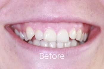Before orthodontic treatment: Anterior Crossbite & Palatal Arch Expansion