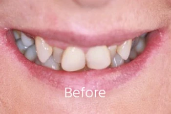 Before orthodontic treatment: Severe Incisor Rotation & Leveling