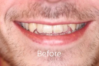 Before orthodontic treatment: Open Bite Closure & Aesthetic Smile Line