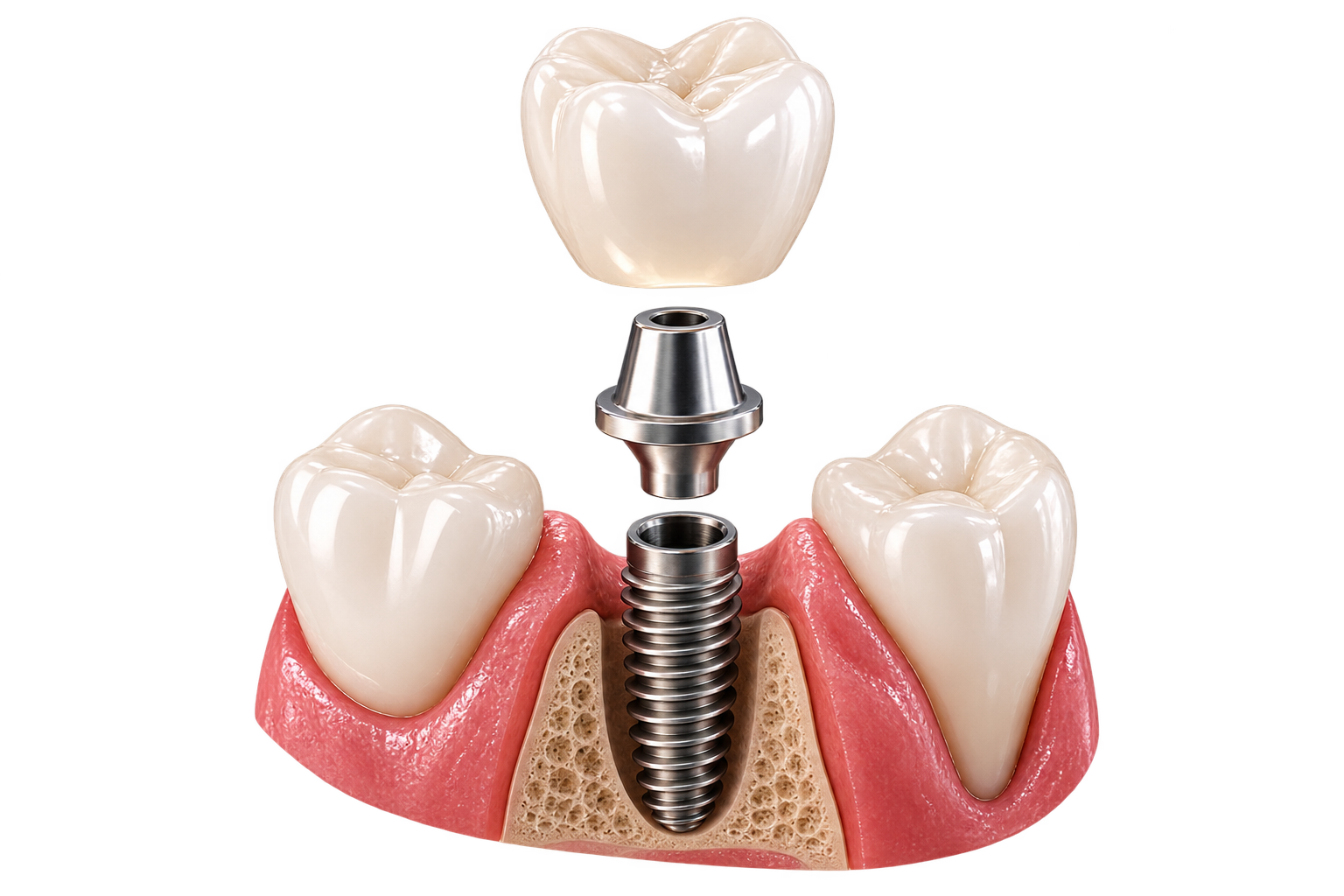 Dental Implants